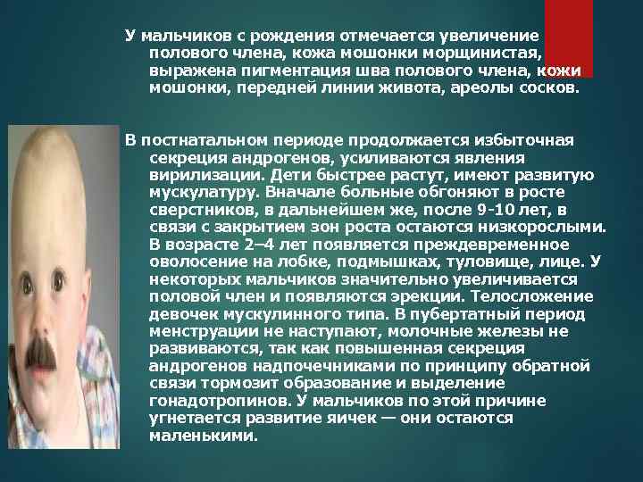 У мальчиков с рождения отмечается увеличение полового члена, кожа мошонки морщинистая, выражена пигментация шва