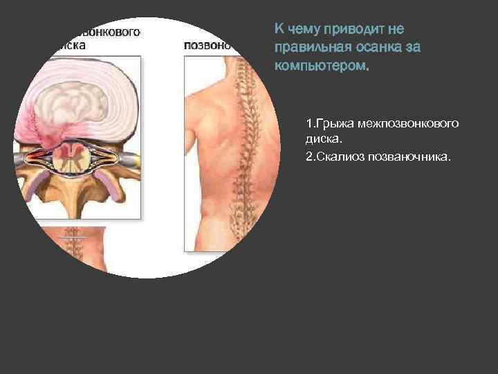 К чему приводит не правильная осанка за компьютером. 1. Грыжа межпозвонкового диска. 2. Скалиоз
