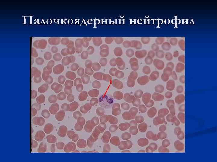 Палочкоядерный нейтрофил 