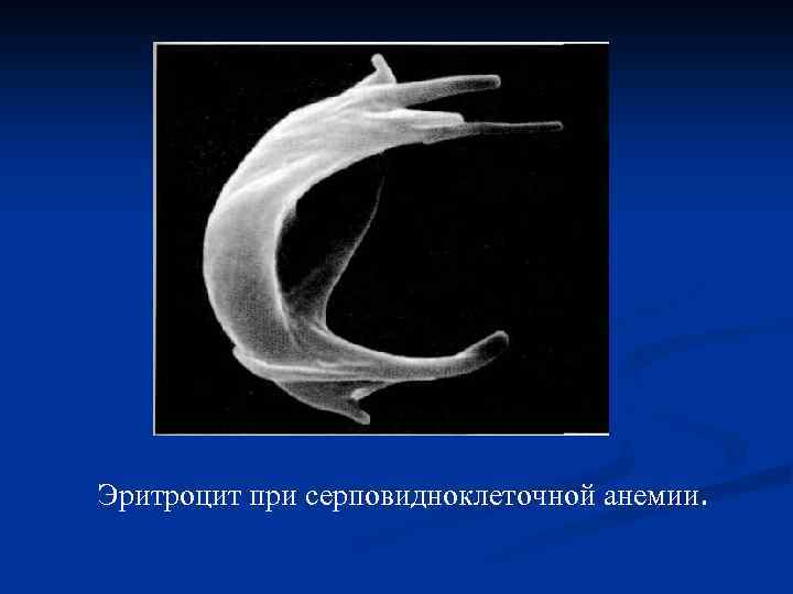 Эритроцит при серповидноклеточной анемии. 