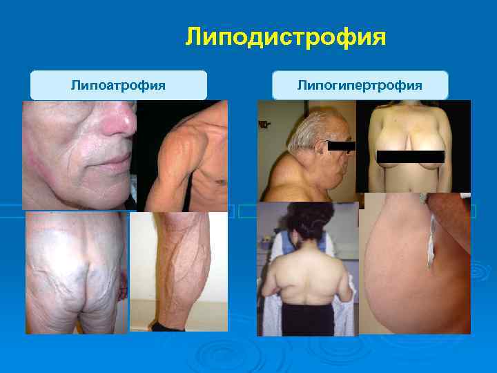  Липодистрофия Липоатрофия Липогипертрофия 