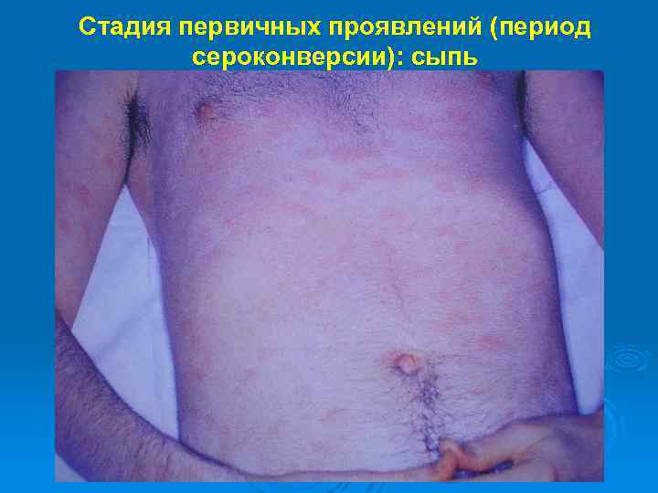 Стадия первичных проявлений (период сероконверсии): сыпь 