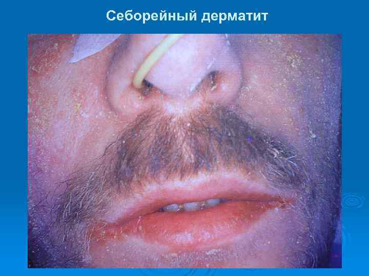 Себорейный дерматит 