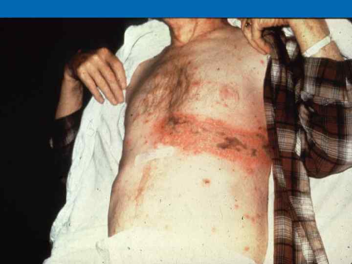 Опоясывающий герпес 