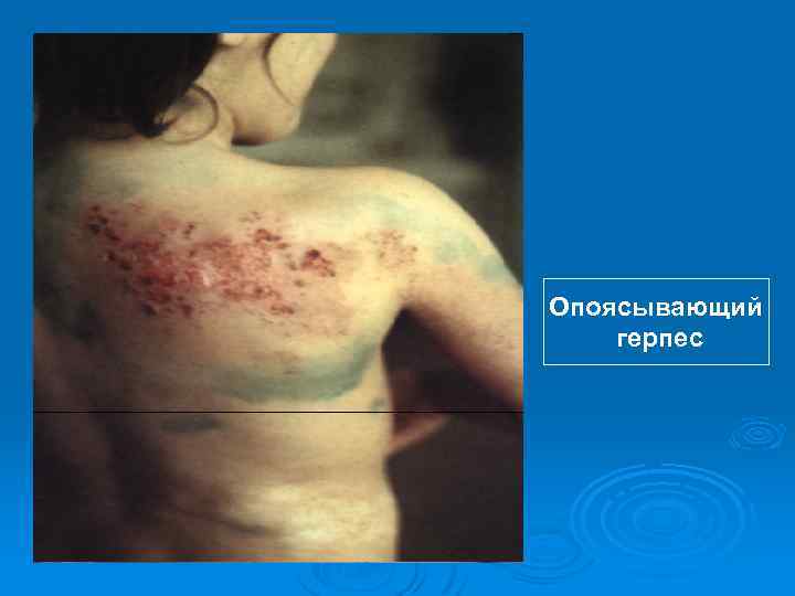 Опоясывающий герпес 