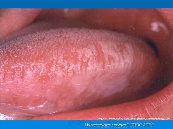 Волосатая лейкоплакия Fitzpatrick, Thomas B. [et al. ]. Color Atlas & Synopsis of Clinical