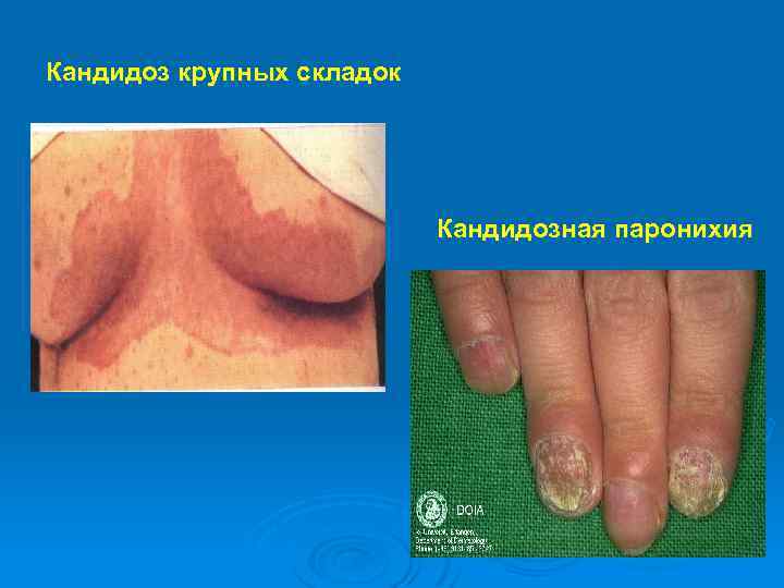 Кандидоз крупных складок Кандидозная паронихия 