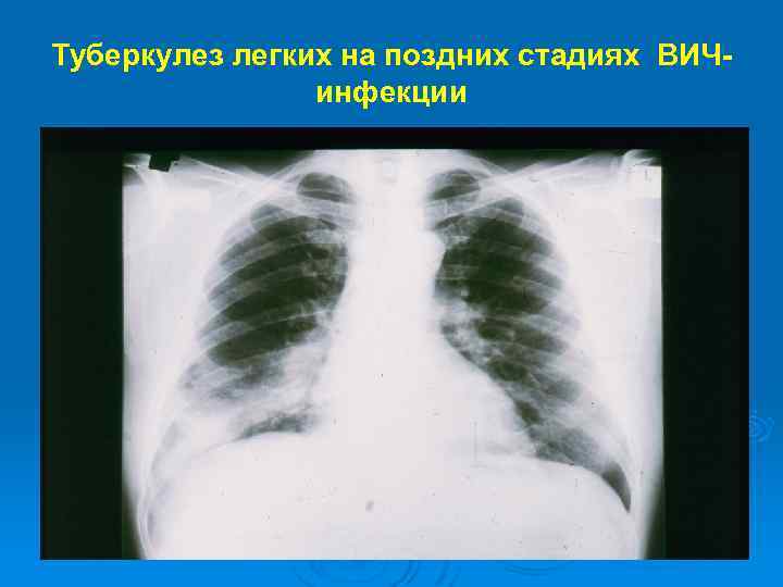Туберкулез легких на поздних стадиях ВИЧинфекции 