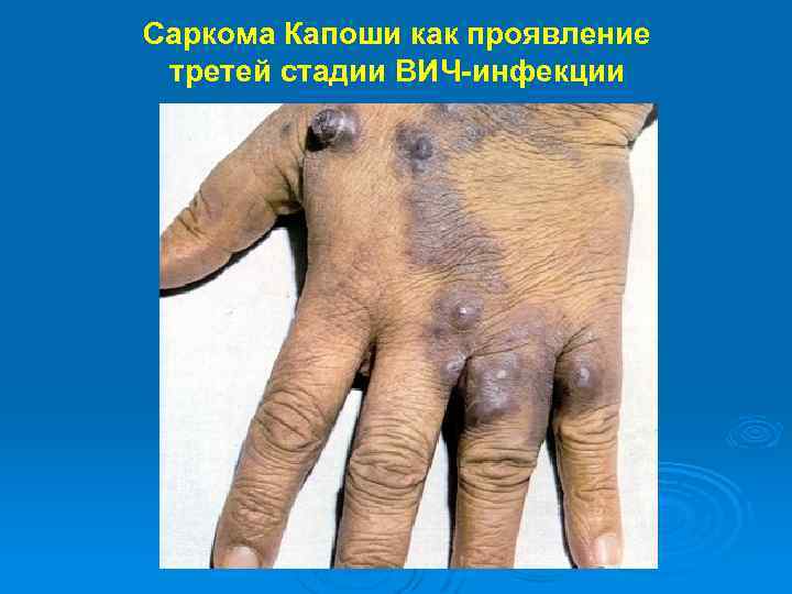 Саркома Капоши как проявление третей стадии ВИЧ-инфекции 