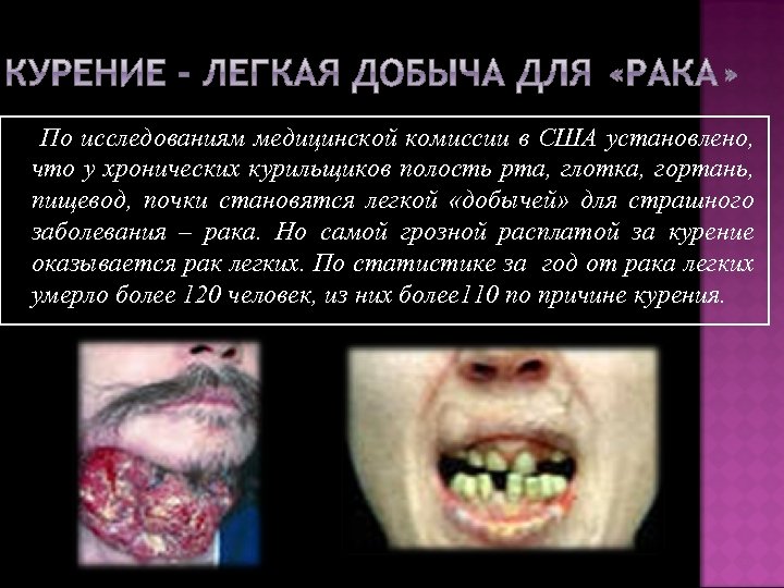 По исследованиям медицинской комиссии в США установлено, что у хронических курильщиков полость рта, глотка,
