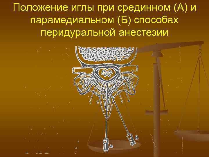 Положение иглы при срединном (А) и парамедиальном (Б) способах перидуральной анестезии 