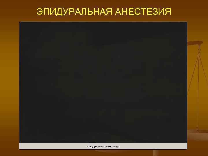 ЭПИДУРАЛЬНАЯ АНЕСТЕЗИЯ 
