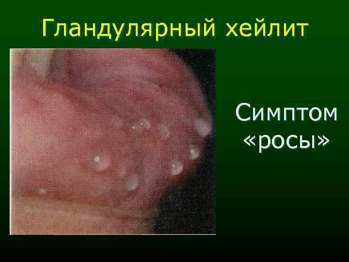 Гландулярный хейлит Симптом «росы» 