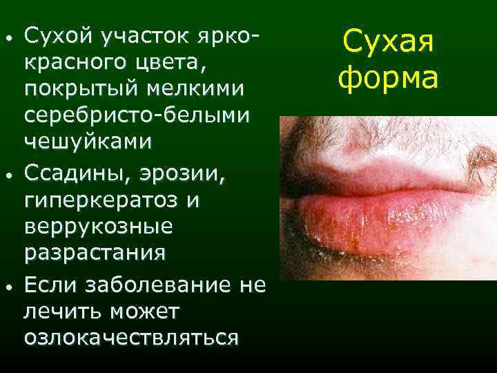  • • • Сухой участок яркокрасного цвета, покрытый мелкими серебристо-белыми чешуйками Ссадины, эрозии,