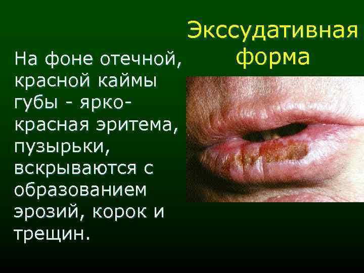 Экссудативная форма На фоне отечной, красной каймы губы - яркокрасная эритема, пузырьки, вскрываются с