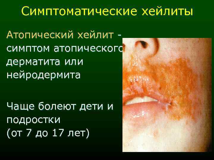 Симптоматические хейлиты Атопический хейлит симптом атопического дерматита или нейродермита Чаще болеют дети и подростки