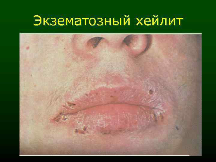 Экзематозный хейлит 