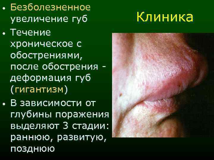  • • • Безболезненное увеличение губ Течение хроническое с обострениями, после обострения деформация