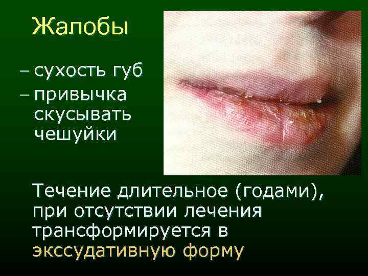 Жалобы - сухость губ - привычка скусывать чешуйки Течение длительное (годами), при отсутствии лечения