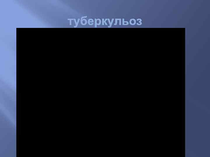 туберкульоз 