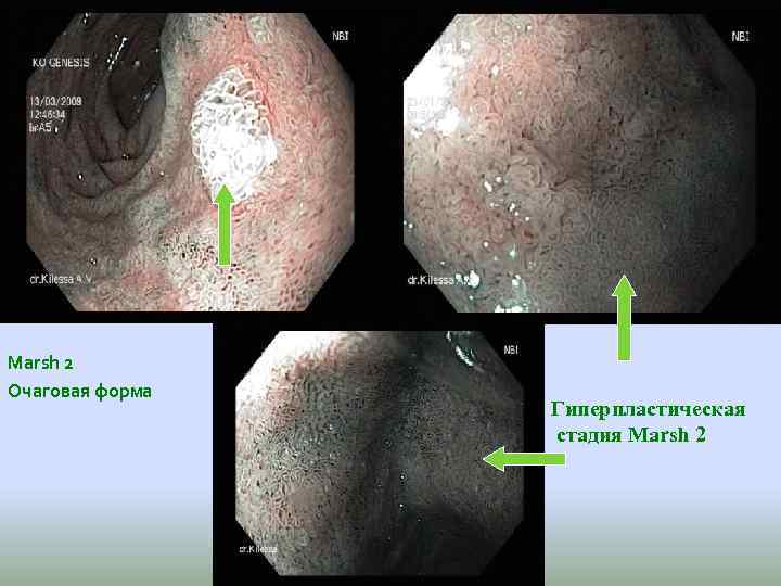 Marsh 2 Очаговая форма Гиперпластическая стадия Marsh 2 