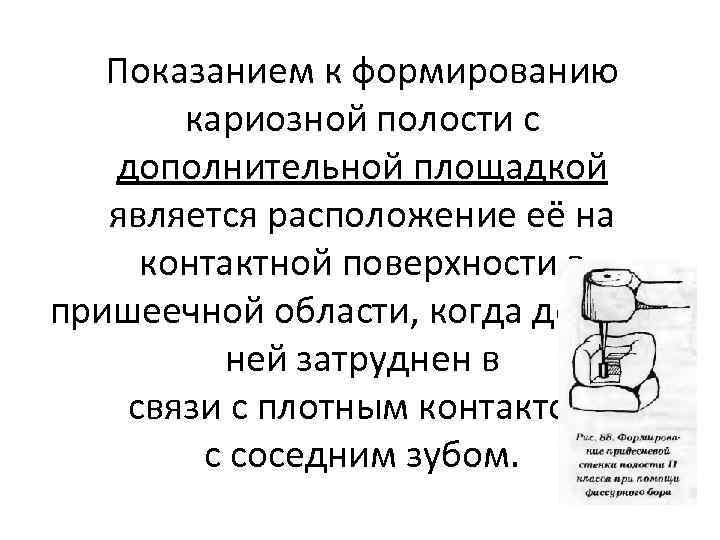 Дополнительные площадки кариозной полости. Требования предъявляемые к сформированной кариозной полости. Доп площадка кариозной полости. Формирование полости 2 класса по Блэку. Формирование кариозной полости III класса с дополнительной площадкой.