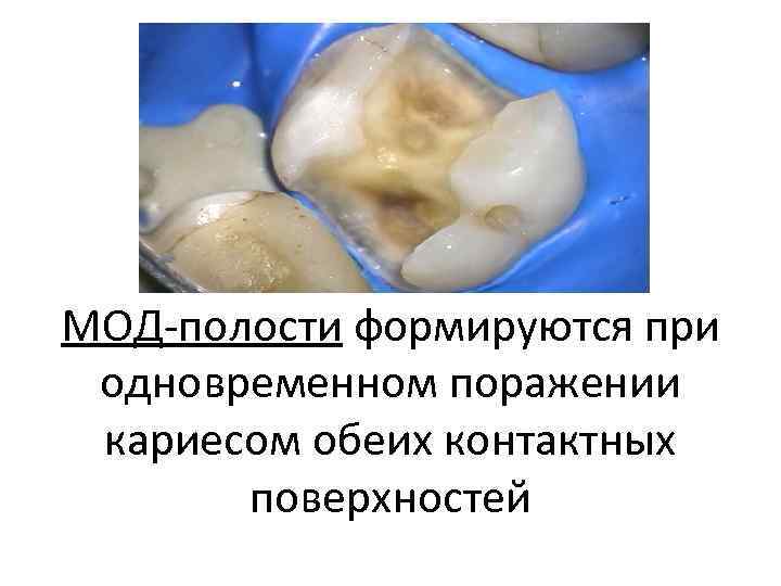 МОД-полости формируются при одновременном поражении кариесом обеих контактных поверхностей 