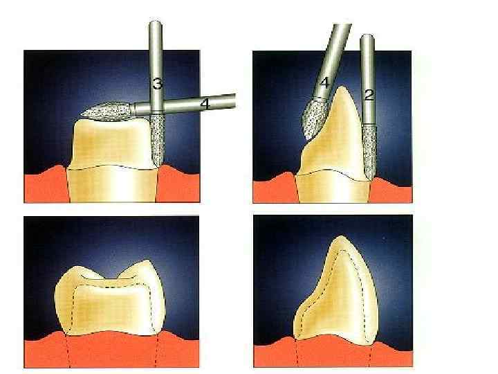 Препарирование зуба. Препарирование зубов (Одонтопрепарирование).. Одонтопрепарирование под штампованную коронку. Препарирование зубов под полукоронки. Этапы препарирования под искусственную коронку.