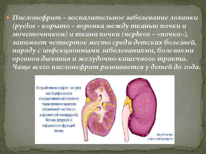  Пиелонефрит – воспалительное заболевание лоханки (pyelos – корыто – воронка между тканью почки