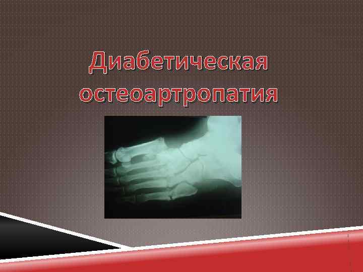 Диабетическая остеоартропатия 