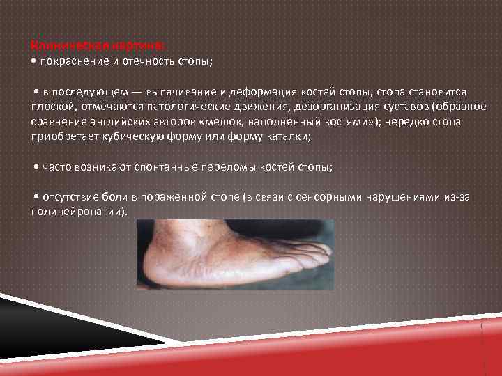 Клиническая картина: • покраснение и отечность стопы; • в последующем — выпячивание и деформация