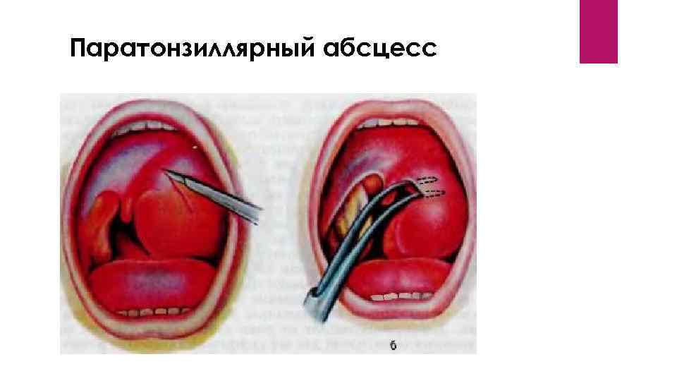 Паратонзиллярный абсцесс 