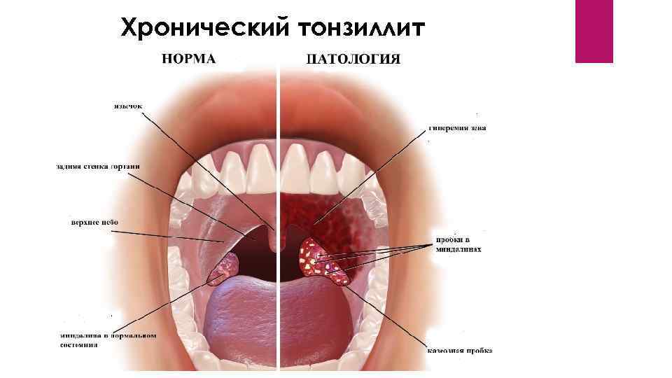 Хронический тонзиллит 