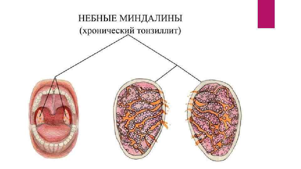 Острый фарингит фото горла