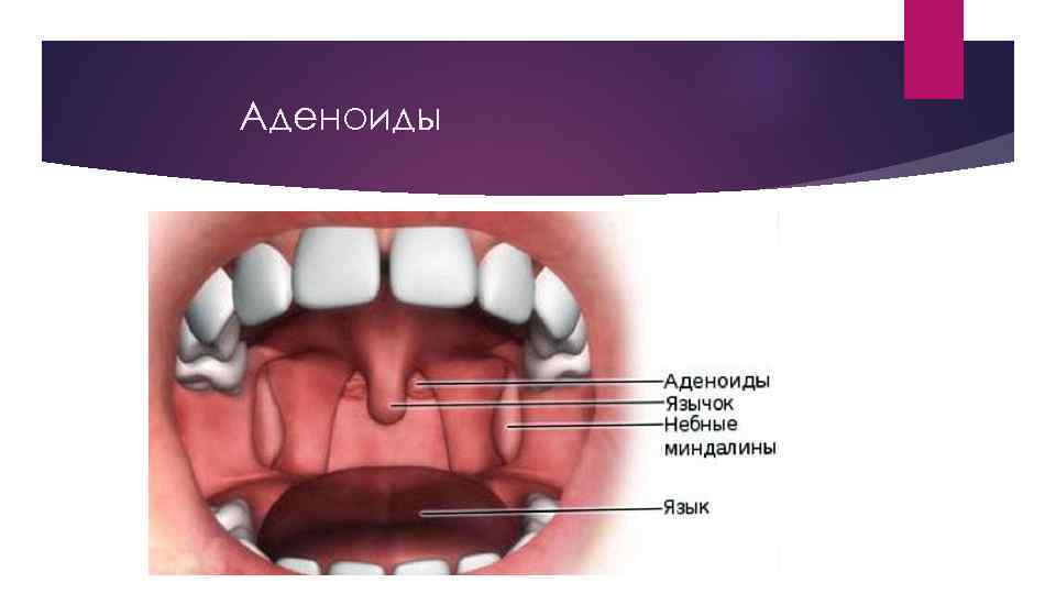 Аденоиды 