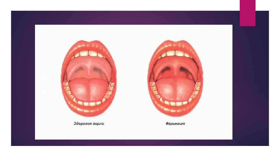 Острый фарингит фото горла