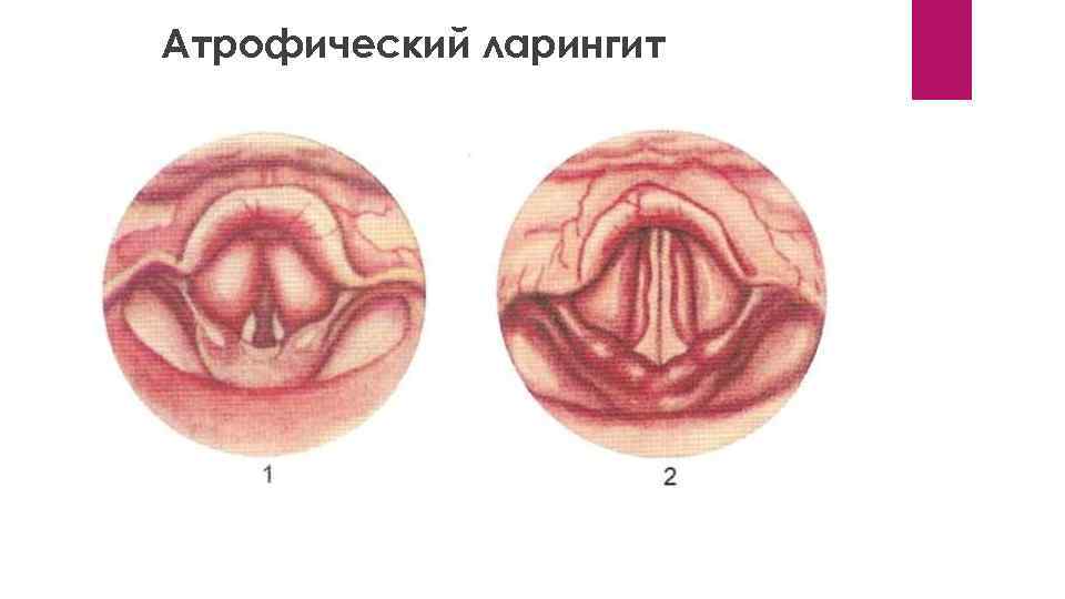 Атрофический ларингит 