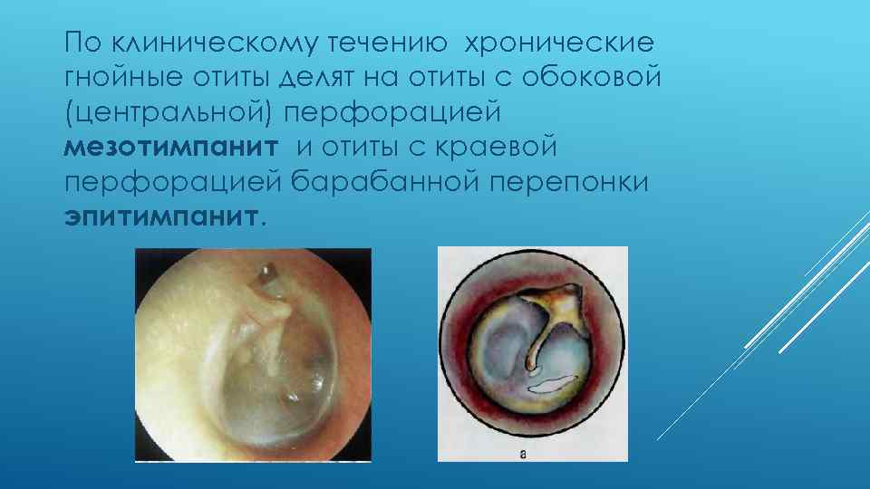 По клиническому течению хронические гнойные отиты делят на отиты с обоковой (центральной) перфорацией мезотимпанит