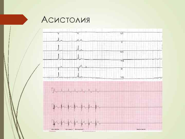 Асистолия 