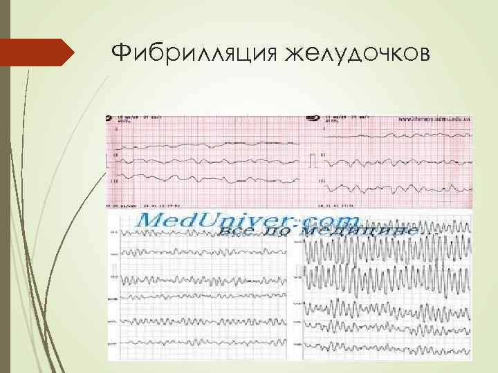 Фибрилляция желудочков 