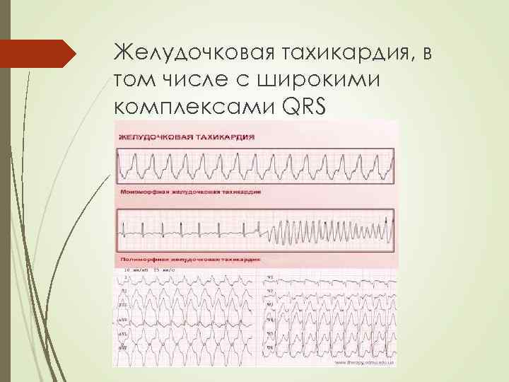 Желудочковая тахикардия, в том числе с широкими комплексами QRS 