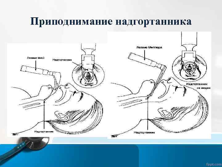 Приподнимание надгортанника 