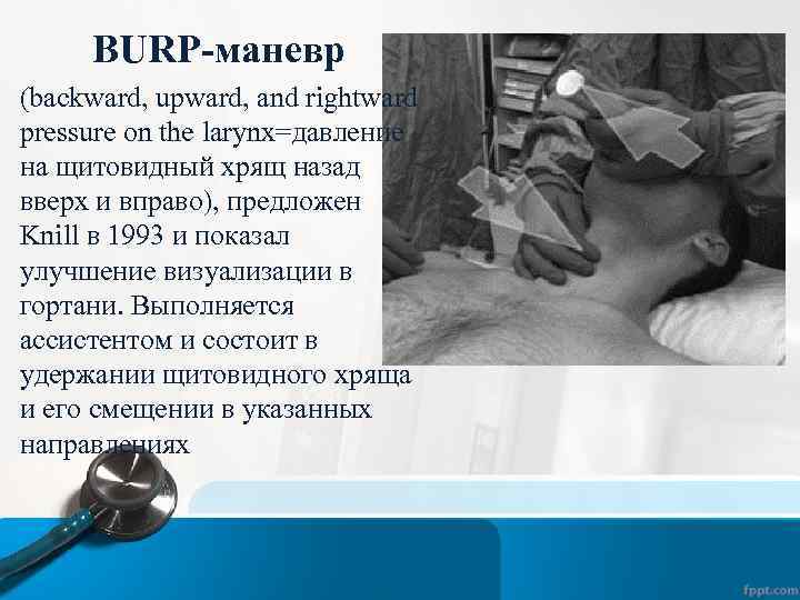 BURP-маневр (backward, upward, and rightward pressure on the larynx=давление на щитовидный хрящ назад вверх