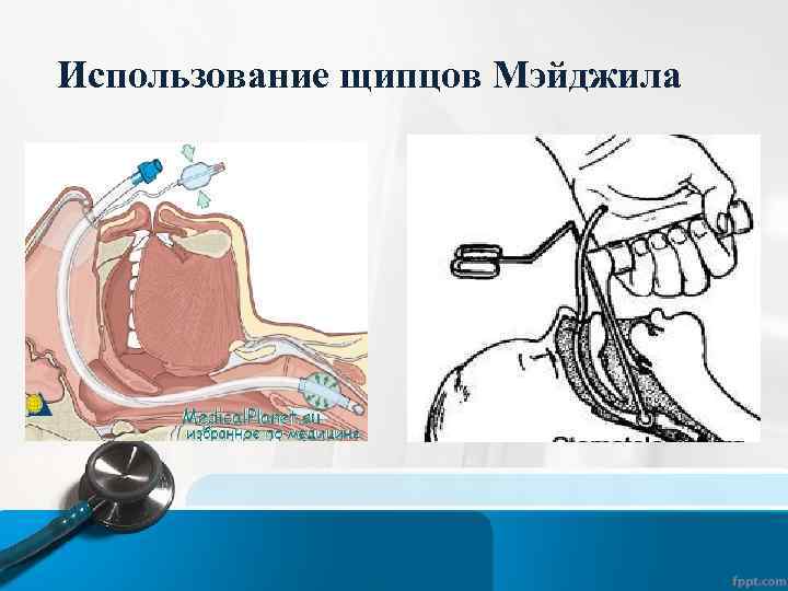 Использование щипцов Мэйджила 