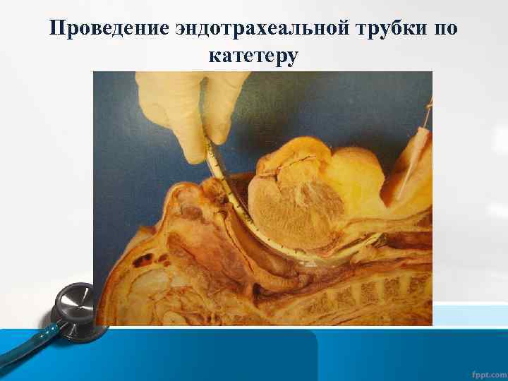 Проведение эндотрахеальной трубки по катетеру 