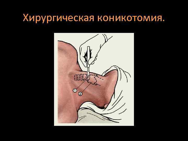 Хирургическая коникотомия. 