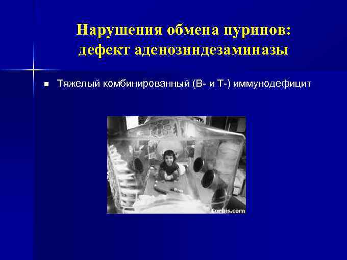 Нарушения обмена пуринов: дефект аденозиндезаминазы n Тяжелый комбинированный (В- и Т-) иммунодефицит 