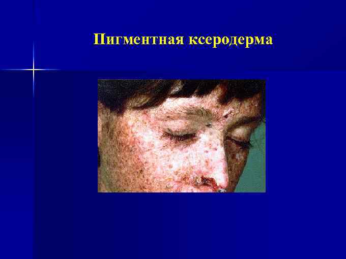 Пигментная ксеродерма 
