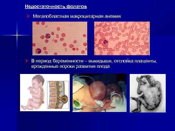 Недостаточность фолатов Ø Мегалобластная макроцитарная анемия Ø В период беременности – выкидыши, отслойка плаценты,