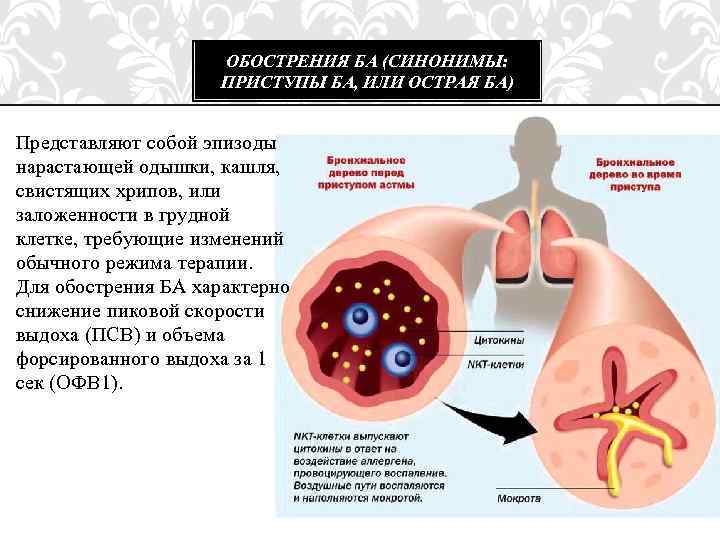 ОБОСТРЕНИЯ БА (СИНОНИМЫ: ПРИСТУПЫ БА, ИЛИ ОСТРАЯ БА) Представляют собой эпизоды нарастающей одышки, кашля,
